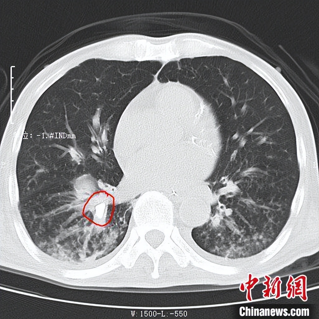 罕见病例揭秘，男子肺中藏牙引发反复发热的启示