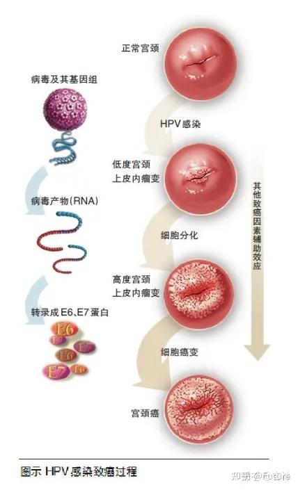 HPV感染的症状