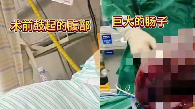 女子结肠巨蟒般盘踞腹中，长年便秘困扰生活