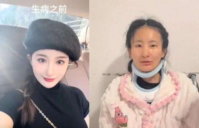 女生渐冻症致容貌巨变，母亲深情守护与支持