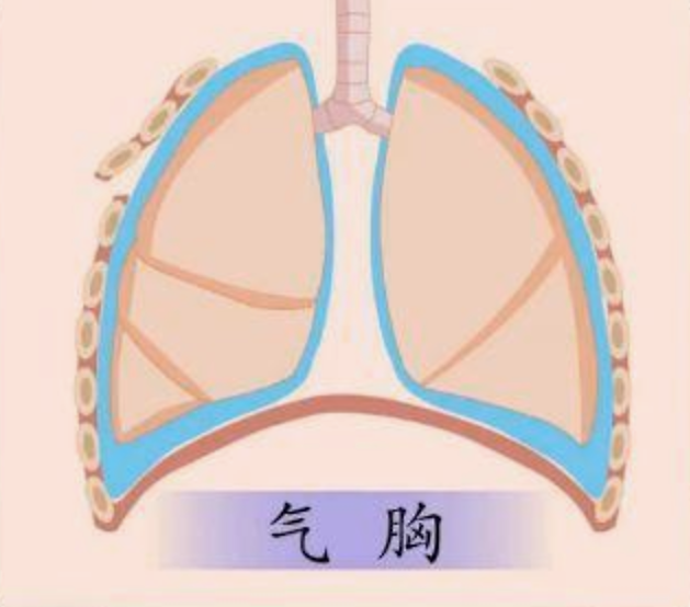 警惕气胸，三类人群需特别关注预防措施